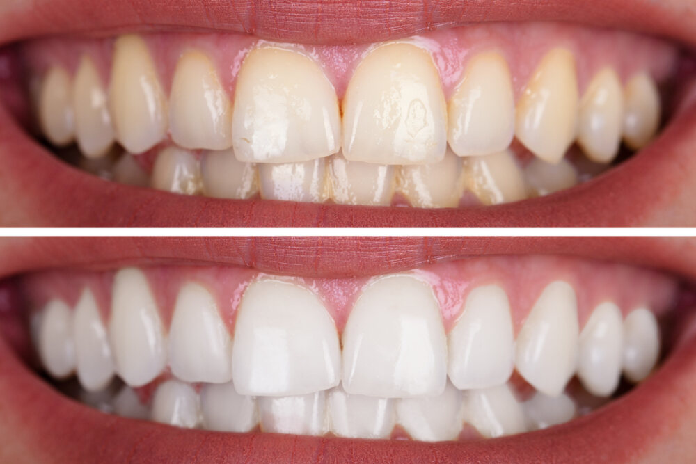 image of yellow and white teeth